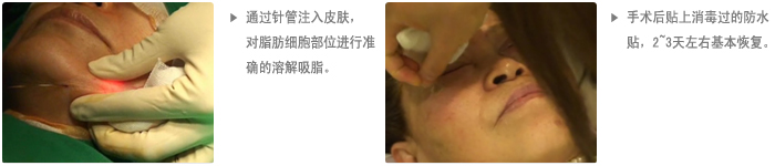 ID整形医院 眼部整形 手术前后照片